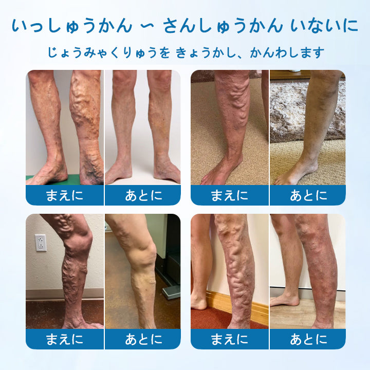 CleraNaure® VeinGuard ハーブスプレー – ✅ 臨床的に証明済み、わずか7日で静脈瘤を除去！