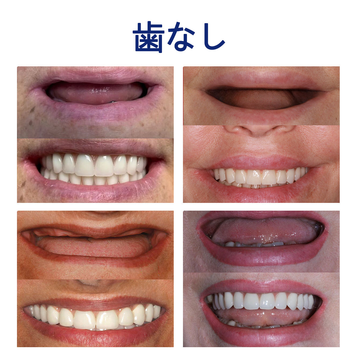 CleraLuxe®シリコーン義歯定規セット（✅ 試験済み・信頼の品質・歯科医師推奨）🔥