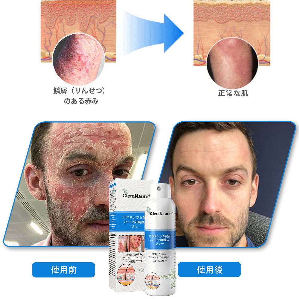CleraNature® マグネシウムスプレー – かゆみ、赤み、敏感肌の即効リリーフ（デリケートゾーンにも対応）